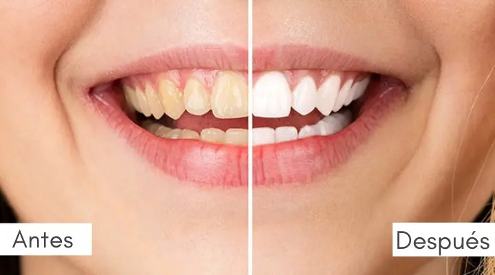 KIT LED para blanqueamiento Dental en 15 minutos