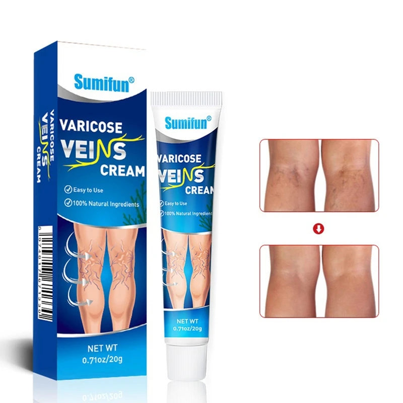 Crema Para Aliviar Varices