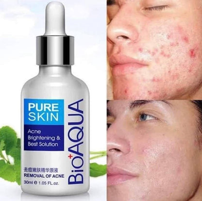 PureGlow Anti-Acné:🌿 Dile adiós a granos, puntos negros y marcas con solo unas gotas al día🔥