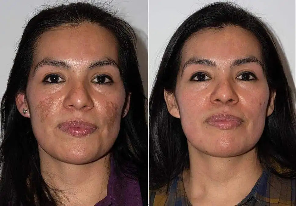 Crema Blanqueadora de Cutis y Manchas - Blancoderma