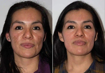 Crema Blanqueadora de Cutis y Manchas - Blancoderma