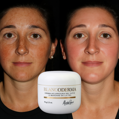 Crema Blanqueadora de Cutis y Manchas - Blancoderma