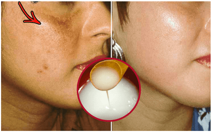 Crema Blanqueadora de Cutis y Manchas - Blancoderma