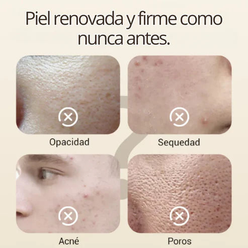 Crema Blanqueadora de Cutis y Manchas - Blancoderma
